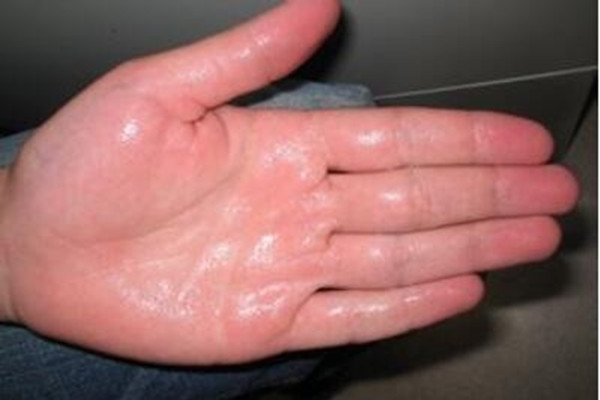 手汗癥怎樣能緩解呢 手汗癥能用中醫(yī)調理嗎