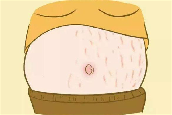 激光去妊娠紋多少錢(qián) 激光去妊娠紋價(jià)格