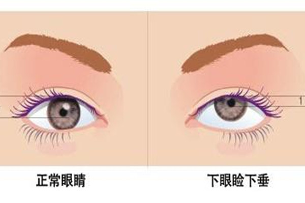 武漢眼瞼下垂手術(shù)哪個(gè)做的好 武漢眼瞼下垂手術(shù)要多少錢