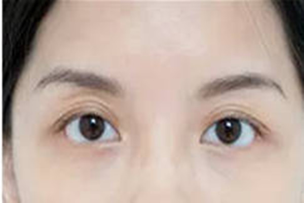 韓式去眼袋第二天會(huì)腫嗎 韓式去眼袋的注意事項(xiàng)