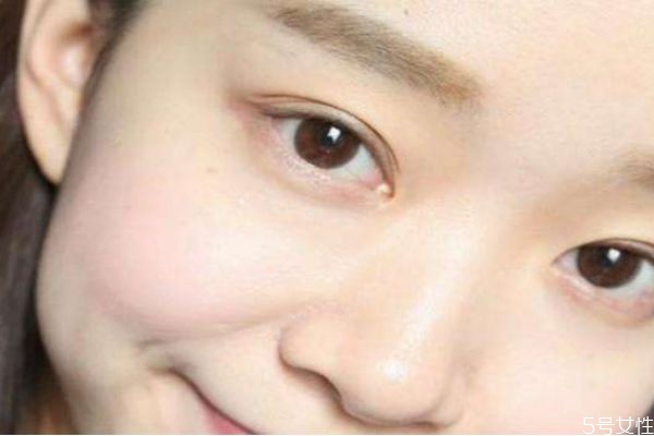 額頭長(zhǎng)閉口是什么情況 為什么額頭反復(fù)長(zhǎng)閉口