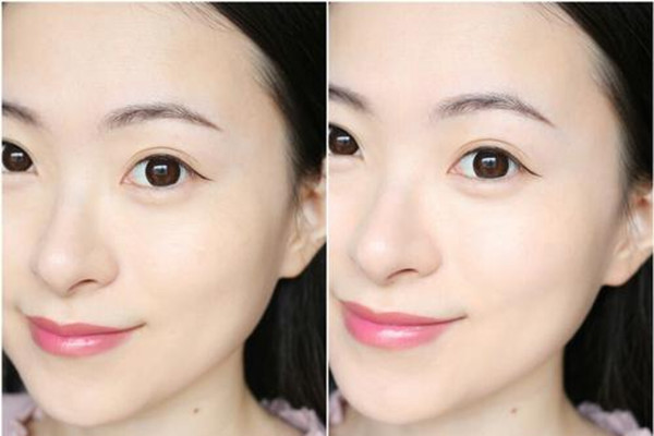 玻尿酸和除皺針的區(qū)別 玻尿酸和除皺針有什么不同 玻尿酸和除皺針的區(qū)別 玻尿酸和除皺針有什么不同