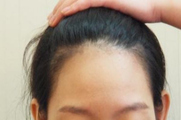 怎么樣讓發(fā)際線變低 如何讓發(fā)際線前移 怎么樣讓發(fā)際線變低 如何讓發(fā)際線前移