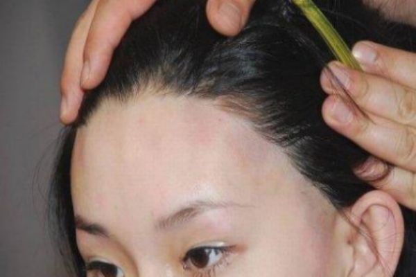 怎么樣讓發(fā)際線變低 如何讓發(fā)際線前移 怎么樣讓發(fā)際線變低 如何讓發(fā)際線前移