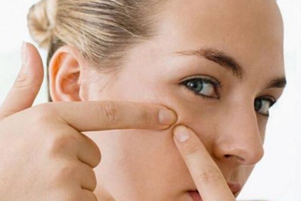 擠痘痘的壞處有什么 為什么不能擠痘痘