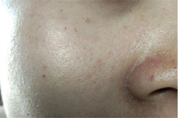 鼻子兩側(cè)毛孔粗大原因及怎么改善