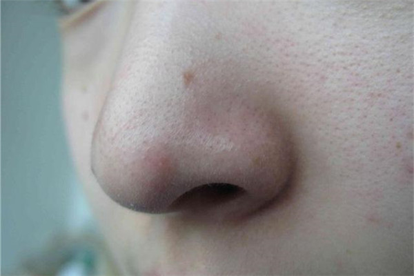 鼻子兩側毛孔粗大原因及怎么改善 鼻子兩側毛孔粗大原因及怎么改善