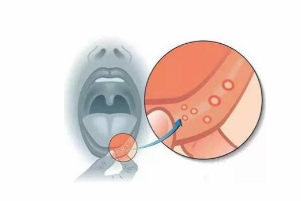 口腔潰瘍?yōu)槭裁催@么疼 口腔潰瘍?yōu)槭裁词前椎?>
               <p class=
