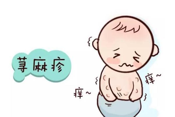 蕁麻疹是否有傳染 蕁麻疹是屬于過敏體質(zhì)嗎 蕁麻疹是否有傳染 蕁麻疹是屬于過敏體質(zhì)嗎