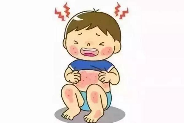 新生兒濕疹可以打預(yù)防針嗎 新生兒濕疹可以用爐甘石嗎 新生兒濕疹可以打預(yù)防針嗎 新生兒濕疹可以用爐甘石嗎
