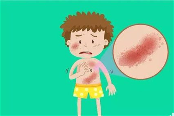 濕氣重會(huì)引起蕁麻疹嗎 濕氣重會(huì)引起皮膚病嗎 濕氣重會(huì)引起蕁麻疹嗎 濕氣重會(huì)引起皮膚病嗎