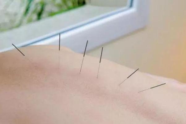 針灸有危險嗎 針灸有什么好處和壞處