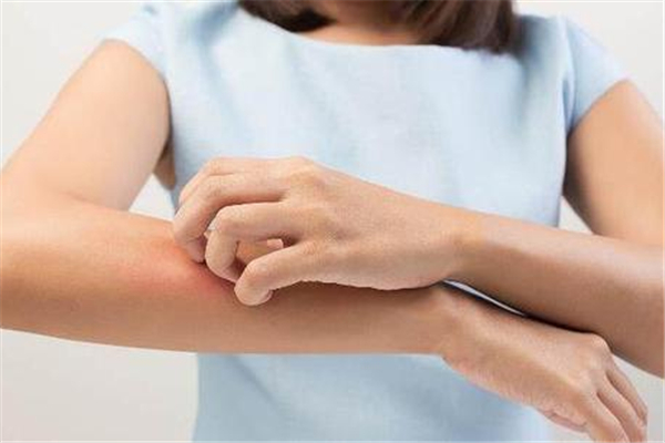 蕁麻疹會(huì)導(dǎo)致手指腫嗎 蕁麻疹的危害
