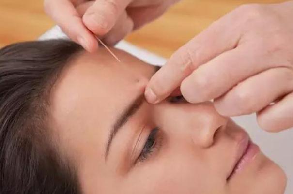 針灸會影響月經(jīng)推遲嗎 針灸會導(dǎo)致月經(jīng)不調(diào)嗎