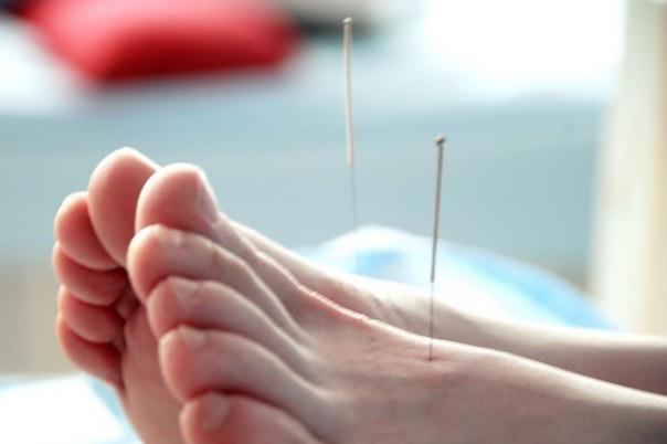 針灸會影響月經(jīng)推遲嗎 針灸會導(dǎo)致月經(jīng)不調(diào)嗎