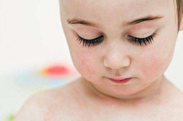 寶寶濕疹反復(fù)是過(guò)敏嗎 寶寶濕疹反復(fù)不好怎么辦 寶寶濕疹反復(fù)是過(guò)敏嗎 寶寶濕疹反復(fù)不好怎么辦