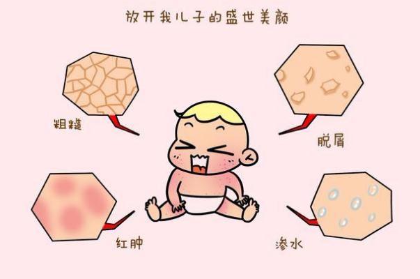 寶寶濕疹反復(fù)是過(guò)敏嗎 寶寶濕疹反復(fù)不好怎么辦 寶寶濕疹反復(fù)是過(guò)敏嗎 寶寶濕疹反復(fù)不好怎么辦