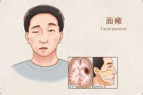 面癱針灸多久會好 面癱針灸治療最佳時間