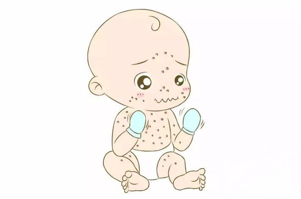水痘會(huì)傳染給大人嗎 水痘會(huì)傳染給嬰兒?jiǎn)? alt=