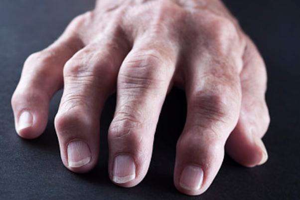 痛風(fēng)要做哪些檢查項目 痛風(fēng)有遺傳性嗎