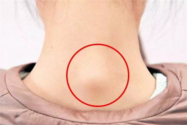 富貴包會引起耳鳴嗎 富貴包會引起腦供血不足嗎