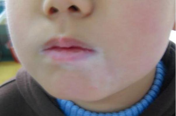 孩子臉上有白斑 孩子臉上有白斑是不是肚子有蟲(chóng)呢
