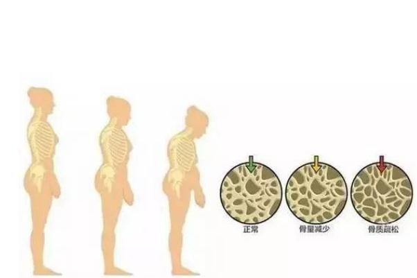 骨質疏松是怎么回事 骨質疏松是什么病 骨質疏松是怎么回事 骨質疏松是什么病