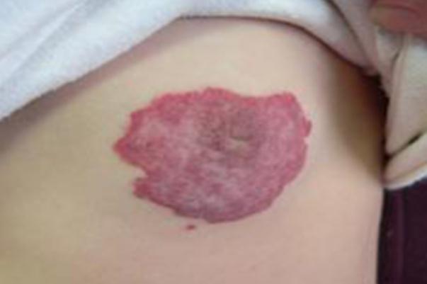 新生兒血管瘤有什么后遺癥嗎 新生兒血管瘤有幾種類型 新生兒血管瘤有什么后遺癥嗎 新生兒血管瘤有幾種類型