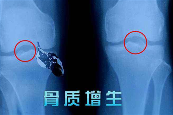 骨質(zhì)增生是怎么引起的 骨質(zhì)增生有哪些癥狀表現(xiàn) 骨質(zhì)增生是怎么引起的 骨質(zhì)增生有哪些癥狀表現(xiàn)