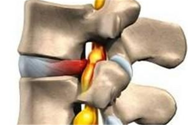骨質(zhì)增生會壓迫神經(jīng)嗎 骨質(zhì)增生會越來越嚴(yán)重嗎