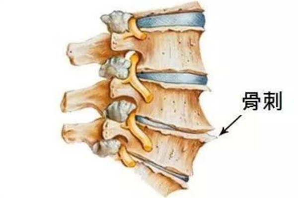 骨質(zhì)增生是怎么引起的 骨質(zhì)增生有哪些癥狀表現(xiàn) 骨質(zhì)增生是怎么引起的 骨質(zhì)增生有哪些癥狀表現(xiàn)