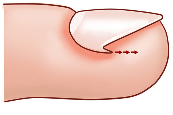 甲溝炎指甲長(zhǎng)出來就好了嗎 甲溝炎指甲長(zhǎng)肉里好深怎么辦