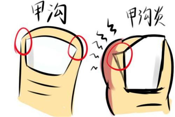 甲溝炎要拔掉整個指甲嗎 甲溝炎指甲拔了還能在長出來嗎 甲溝炎要拔掉整個指甲嗎 甲溝炎指甲拔了還能在長出來嗎