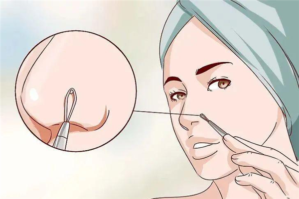 黑頭毛孔粗大怎么辦 黑頭會導致毛孔粗大嗎 黑頭毛孔粗大怎么辦 黑頭會導致毛孔粗大嗎