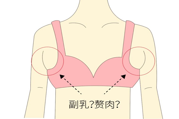 副乳怎么可以消除 副乳有什么危害嗎 副乳怎么可以消除 副乳有什么危害嗎