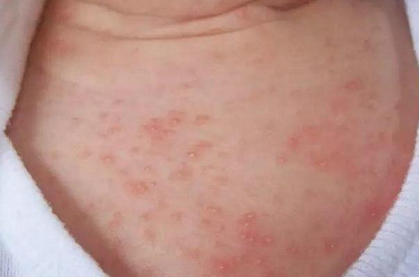 寶寶長痱子用什么擦效果好 寶寶長痱子怎么快速消除止癢 寶寶長痱子用什么擦效果好 寶寶長痱子怎么快速消除止癢