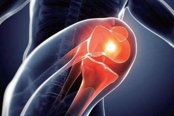 關(guān)節(jié)炎是缺鈣引起的嗎 關(guān)節(jié)炎是遺傳病嗎 關(guān)節(jié)炎是缺鈣引起的嗎 關(guān)節(jié)炎是遺傳病嗎