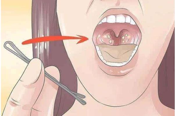 扁桃體發(fā)炎有膿點嚴(yán)重嗎 扁桃體發(fā)炎有遺傳性嗎