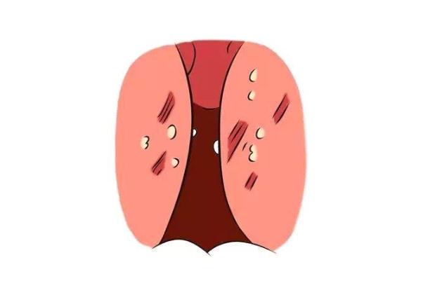 扁桃體發(fā)炎有膿點嚴(yán)重嗎 扁桃體發(fā)炎有遺傳性嗎