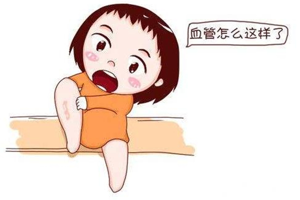 靜脈曲張是怎么引起的 靜脈曲張的表現(xiàn)癥狀 靜脈曲張是怎么引起的 靜脈曲張的表現(xiàn)癥狀