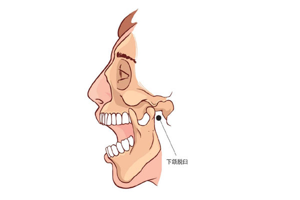 下巴脫臼是什么感覺 下巴脫臼是什么原因 下巴脫臼是什么感覺 下巴脫臼是什么原因
