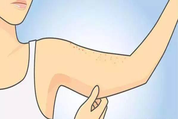 雞皮膚能不能治好 雞皮膚如何治療 雞皮膚能不能治好 雞皮膚如何治療