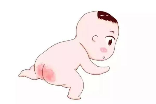 寶寶紅屁股怎么護理 寶寶紅屁股什么原因?qū)е?>
               <p class=