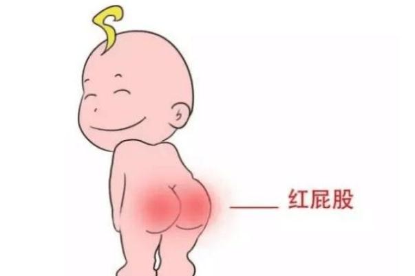 寶寶紅屁股怎么護(hù)理 寶寶紅屁股什么原因?qū)е? alt=
