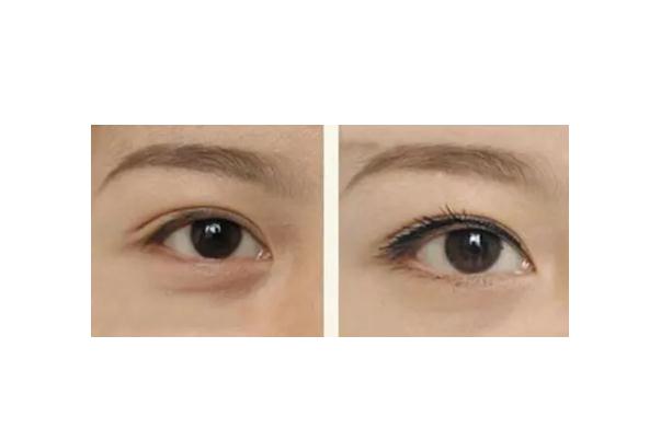 眼袋有細(xì)紋了怎么消除 眼袋上有細(xì)紋怎么解決 眼袋有細(xì)紋了怎么消除 眼袋上有細(xì)紋怎么解決