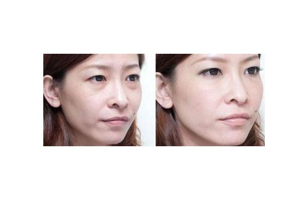 眼袋有細(xì)紋了怎么消除 眼袋上有細(xì)紋怎么解決 眼袋有細(xì)紋了怎么消除 眼袋上有細(xì)紋怎么解決