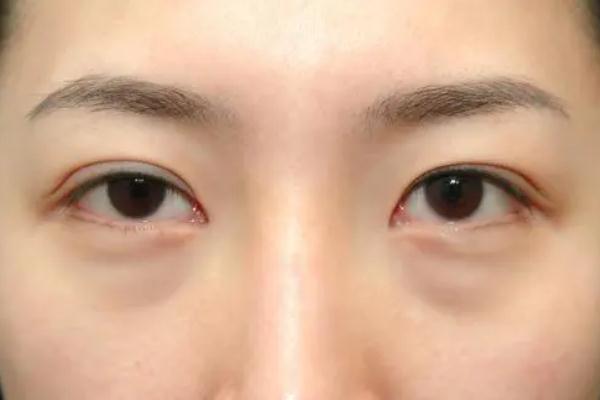 眼袋怎么去除最有效果 眼袋的形成原因