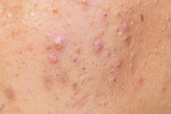 粉刺有膿包怎么處理 粉刺有白色的膿要不要擠掉 粉刺有膿包怎么處理 粉刺有白色的膿要不要擠掉