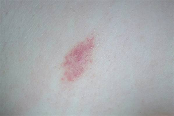 吻痕一般幾天能消除 吻痕怎么快速消除 吻痕一般幾天能消除 吻痕怎么快速消除