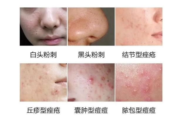 粉刺是什么原因長(zhǎng)出來的 粉刺怎么可以有效的去除